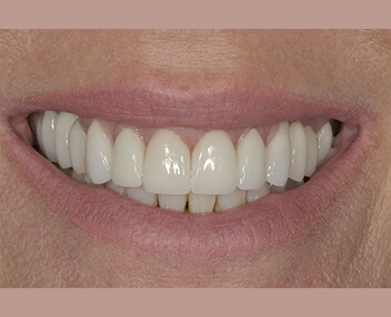 After: a brighter, even smile