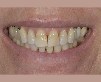 Before treatment
