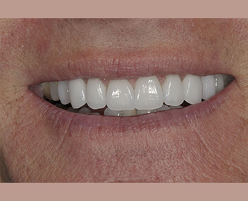 After: a brighter, even smile