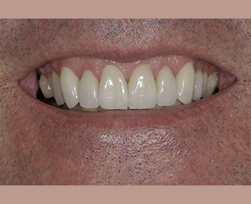 After: a brighter, even smile