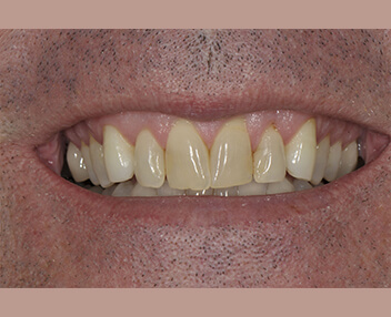 Before treatment