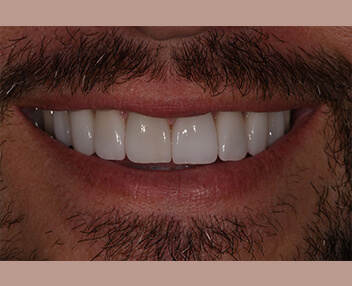 After: a brighter, even smile