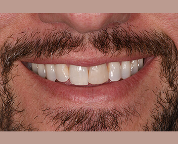 Before treatment