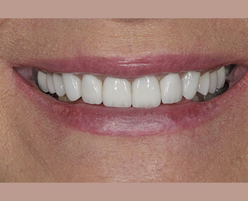 After: a brighter, even smile