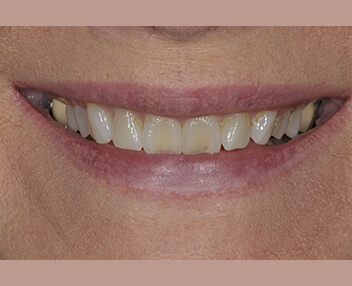 Before treatment