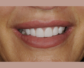 After: a brighter, even smile
